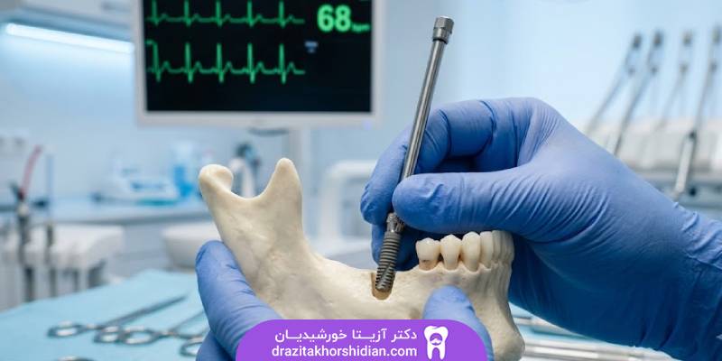 ایمپلنت بیماران قلبی