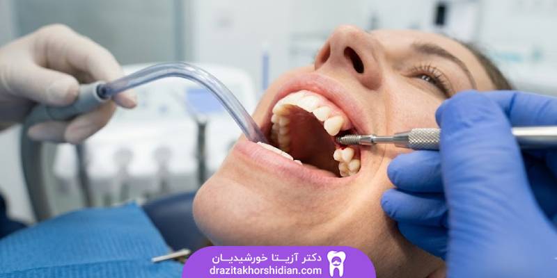 ایمپلنت فوری