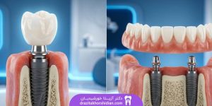 تفاوت ایمپلنت تک دندان با اوردنچر