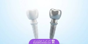 ایمپلنت زیرکونیا و تیتانیوم