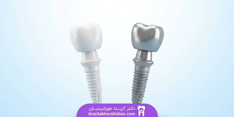 ایمپلنت زیرکونیا و تیتانیوم